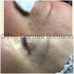 Before and After Medilift Signature facial Eye Area