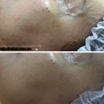 Dermapen before and after image for skin rejuvenation