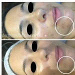 Dermapen before and after image