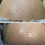 Before and After image Medilift Signature Facial Treatment