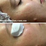Before and After Medilift Signature Facial