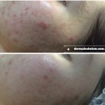 Before and After Image for Acne Treatment