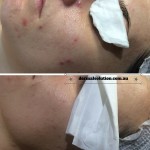 Acne Treatment Before and After Image