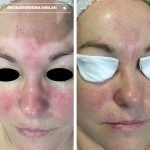 Before and After image Rosacea