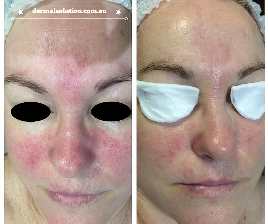 Rosacea Front View Before and After ProDermal Planning Treatments Dermal Solution