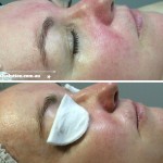 Before and After Rosacea Image
