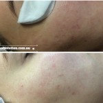 Before and After Dermapen Acne Scarring Image
