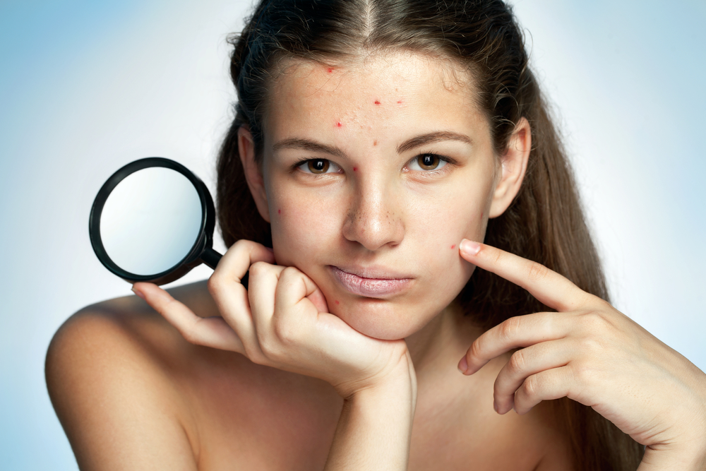 Acne Photo Facial Treatment